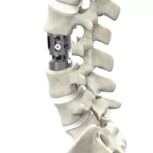 Trauhui  – Implante de Corpectomía