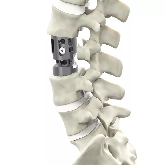 Trauhui  – Implante de Corpectomía